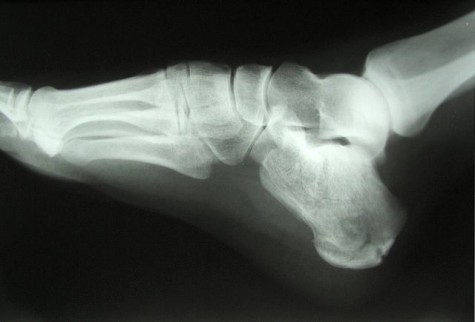 640px-Calcaneus_Fracture