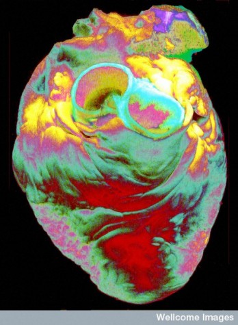 B0005636 Enhanced image of a human heart