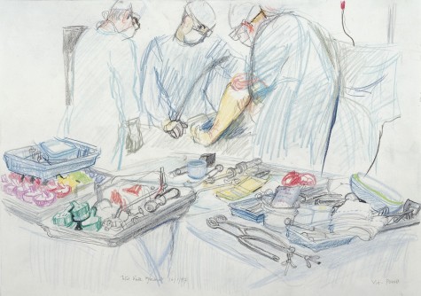 L0028360 A surgical operation: total knee replacement. Drawing by Vir Credit: Wellcome Library, London. Wellcome Images images@wellcome.ac.uk http://wellcomeimages.org A surgical operation: total knee replacement. Drawing by Virginia Powell, 1997. Lettering: Total knee replacement 16/1/97 Virg- Powell Observed at Chelsea and Westminster Hospital, Fulham Road, London. In the foreground are trial moulds for different sizes of artificial knee, some red, some mauve, some green. Copyright The Wellcome Trust Drawing 1997 By: Virginia PowellPublished: 16 January 1997 Copyrighted work available under Creative Commons Attribution only licence CC BY 4.0 http://creativecommons.org/licenses/by/4.0/