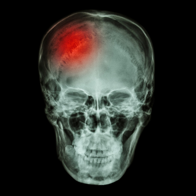 Brain Cancer Skull Cancerwalls